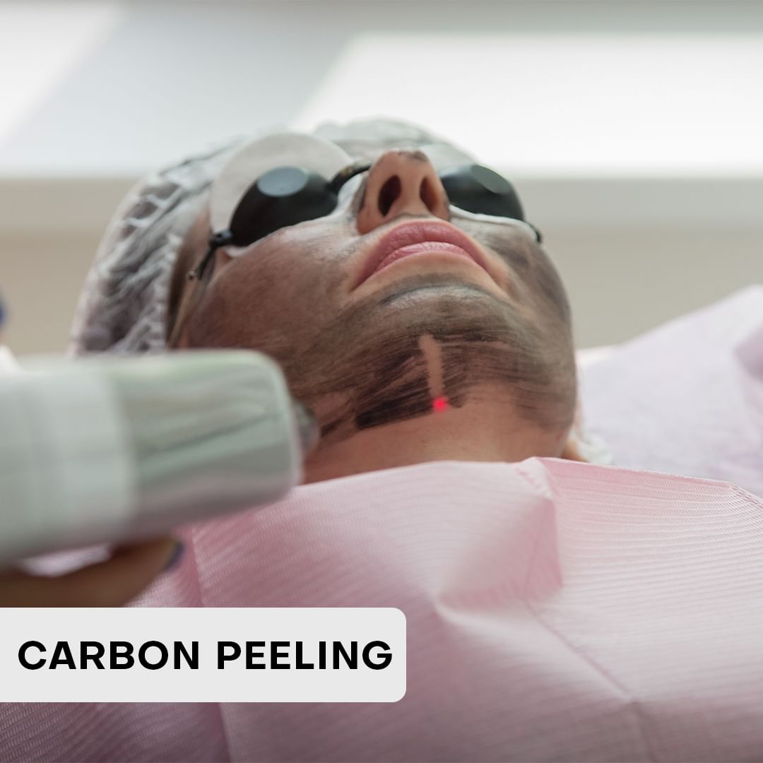 carbon peeling