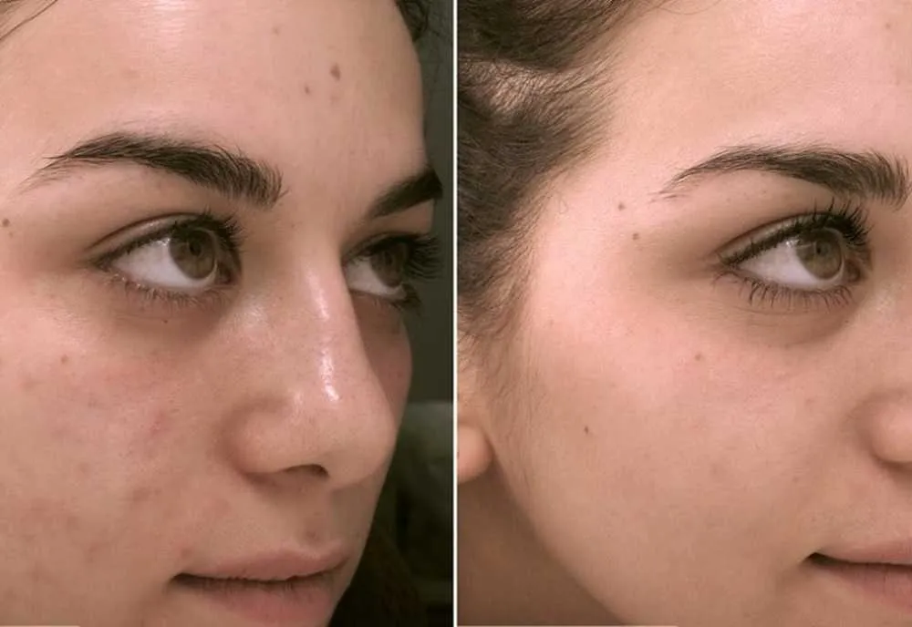 Before Treatment