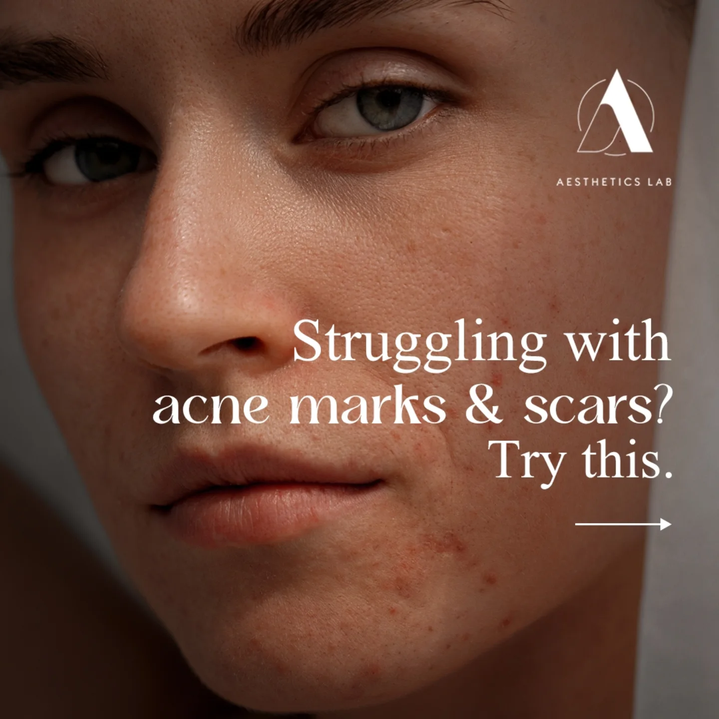 Professional performing advanced Microneedling treatment at Aesthetics Lab